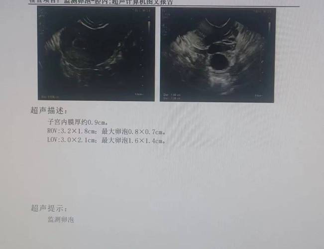 卵泡监测B超检查